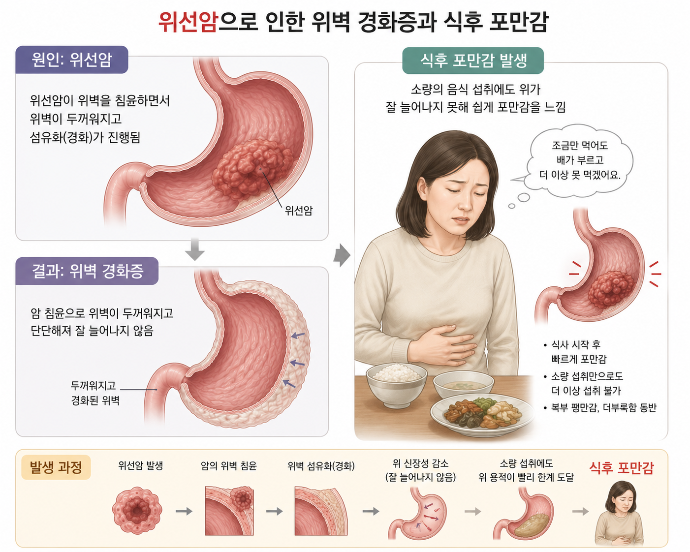 가죽 주머니위(위벽경화증)